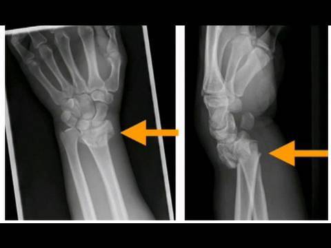 wrist torus fracture