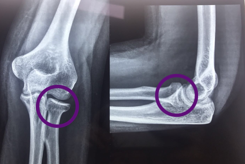 Elbow Fracture Info 3332